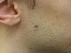 Cost of Laser Mole Removal