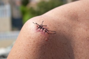 Mole Removal Stitches