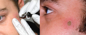 Birthmark Mole Removal
