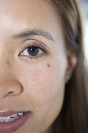 Black Mole Removal