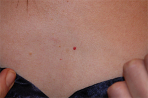Cherry Mole Removal