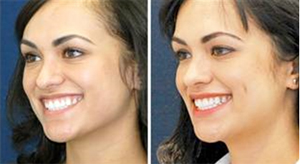 Cosmetic Mole Removal