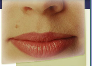 Facial Mole Removal Scarring
