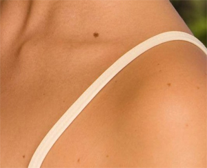 Flat Mole Removal