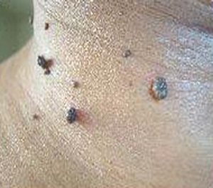 Large Mole Removal