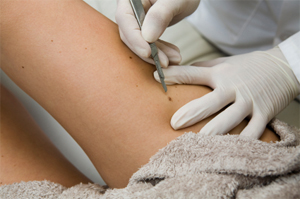 Mole Removal in Cardiff