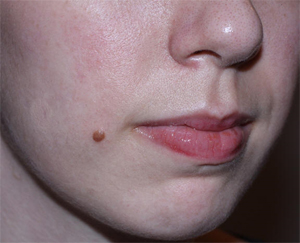 Raised Mole Removal