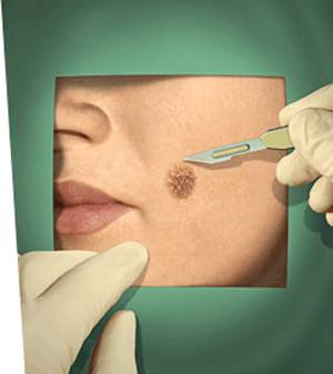 Skin Mole Removal