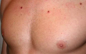 Small Mole Removal